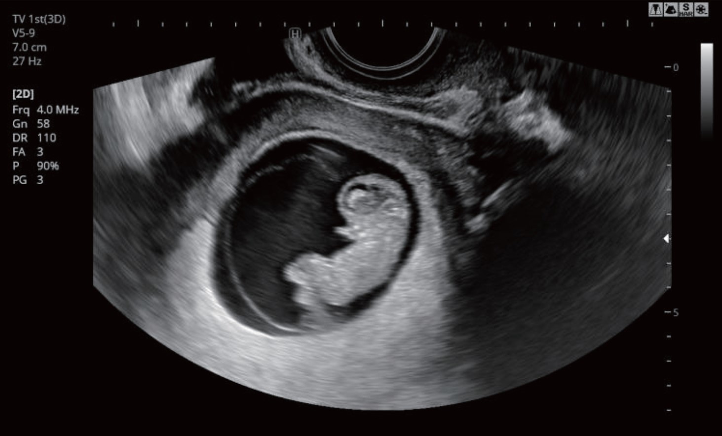 妊娠初期胎児2D画像