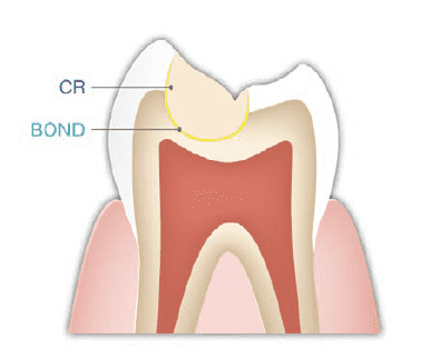 図１．天然歯の構造とコンポジット修復の模式図