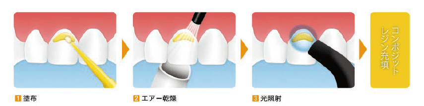 図２．１液性歯科用接着材の使用方法